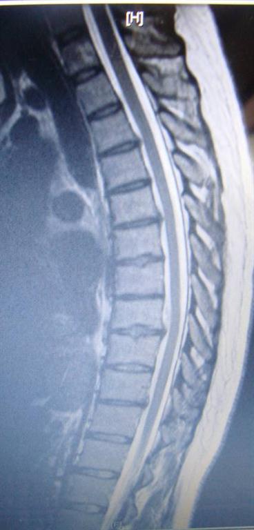 thoracic disc herniation treated by Manchester chiropractor